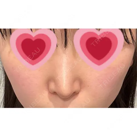 鼻尖形成（切開） / 小鼻縮小（切開） / 軟骨移植 / 鼻修正 / 鼻柱下降・鼻唇角形成（猫手術） R Beauty CLINIC 大阪院 AFTER