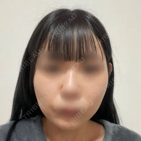 ヒアルロン酸注入（鼻翼基部） 日比谷セントラルクリニック AFTER