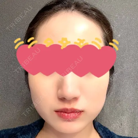 糸リフト / 脂肪吸引（顔） / 脂肪吸引注射（顔） ziz CLINIC AFTER