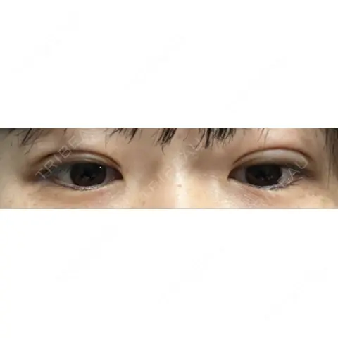 二重埋没 / 自然癒着法 Brandnew Beauty Clinic DAY 0