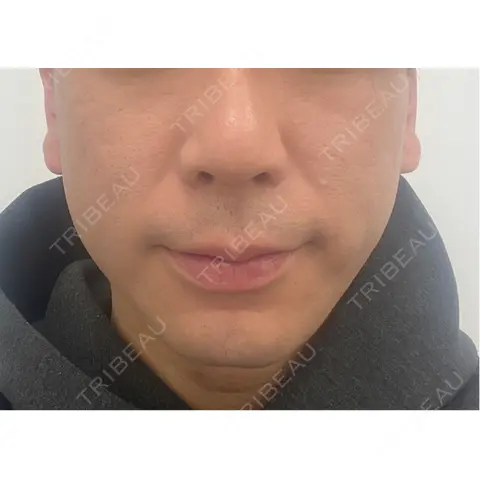 糸リフト / バッカルファット除去 / 脂肪吸引（顔） BLINC CLINIC （ブリンク クリニック） AFTER