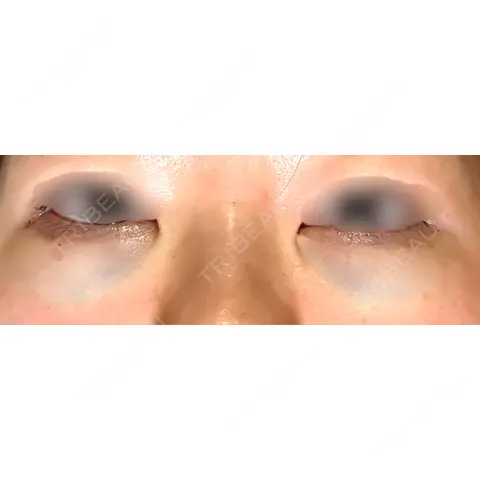 下まぶたの脂肪取り APOLLO BEAUTY CLINIC DAY 0