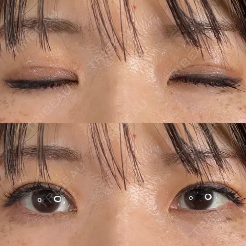 二重埋没 藤・ナチュレ美容クリニック 銀座院 AFTER