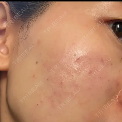 肌育注射（ジュベルックなど） Natural Skin Clinic 自由ヶ丘院 DAY 0