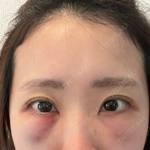 クマ治療 藤・ナチュレ美容クリニック 銀座院 DAY 1