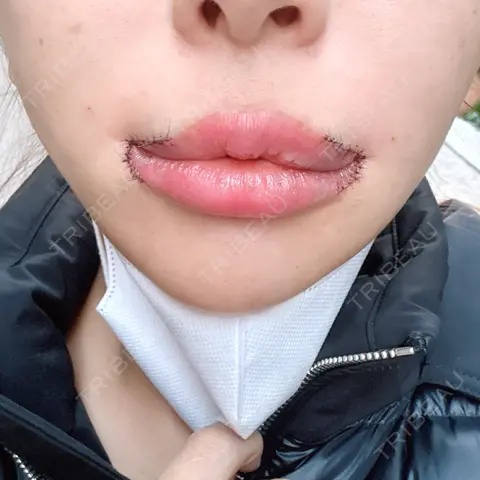 人中短縮 / 口角挙上 R Beauty CLINIC 銀座院 AFTER