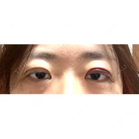 二重埋没 アリエル美容クリニック 大宮院 DAY 0