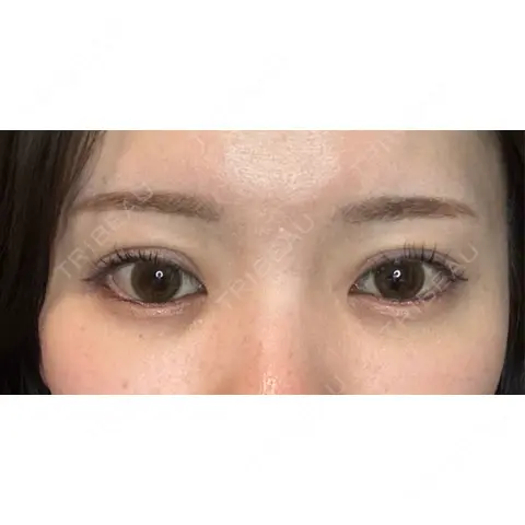 二重埋没 湘南美容クリニック 池袋東口院 AFTER
