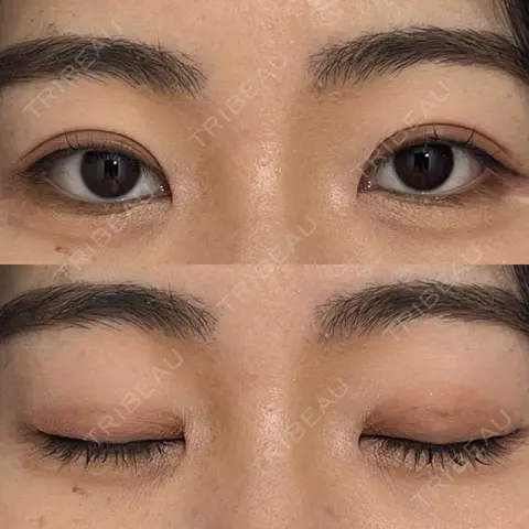 二重埋没 WOM CLINIC GINZA （ワム クリニック ギンザ） AFTER