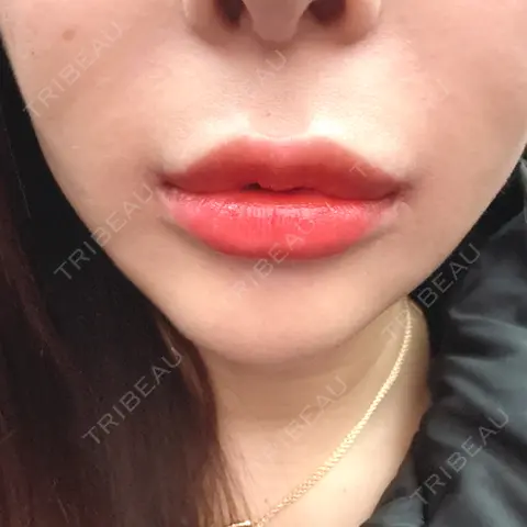 人中短縮 / 口角挙上 R Beauty CLINIC 銀座院 AFTER