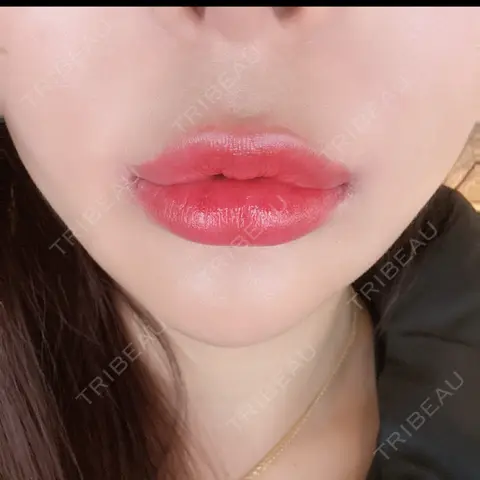 人中短縮 / 口角挙上 R Beauty CLINIC 銀座院 AFTER