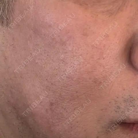 ピーリング（ハリ・ツヤ） Re:anne clinic 銀座 【リアンクリニック銀座】 AFTER