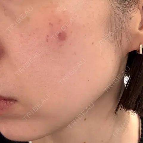ボトックス（眉間） / 光治療（フォトフェイシャルなど） / ピコスポット Kaleido Clinic（カレイドクリニック） 横浜 DAY 0