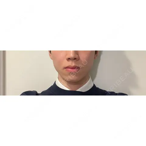 ボトックス（首） KAGA CLINIC DAY 0