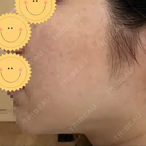 ボトックス（エラ・小顔） L‘amour clinic Tokyo【ラムールクリニック東京】 AFTER