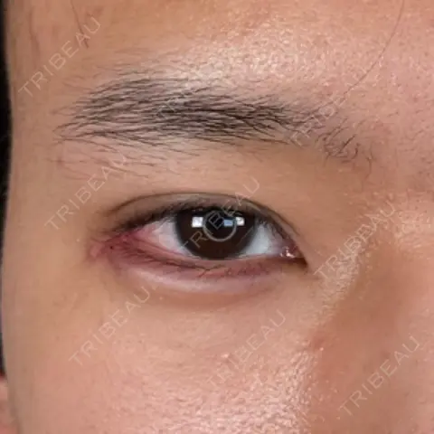 二重埋没 / 鼻尖形成（切開） / 口唇縮小術 / 目尻切開 / タレ目形成・グラマラスライン（切開） / 軟骨移植 / 眉間プロテーゼ アリエル美容クリニック 大宮院 AFTER