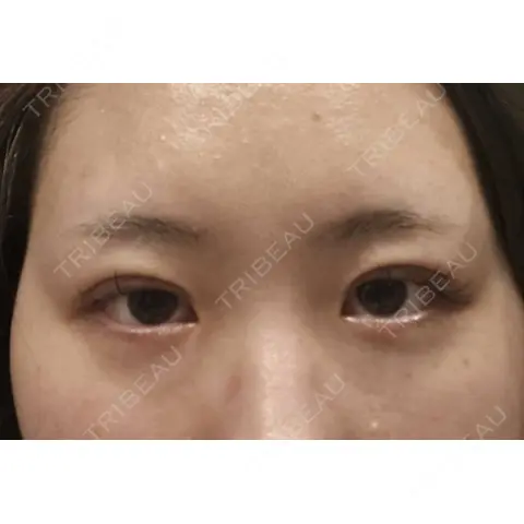 二重埋没 HAAB×DREAM BEAUTY CLINIC 大阪梅田院 DAY 0