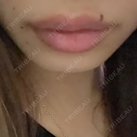 ヒアルロン酸注入（涙袋） / ヒアルロン酸注入（唇） HAAB×DREAM BEAUTY CLINIC 大阪梅田院 AFTER