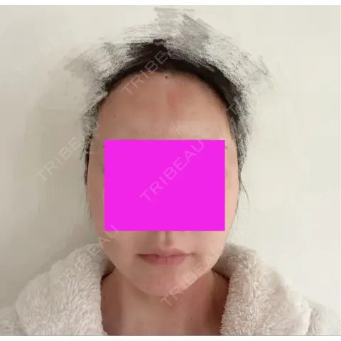バッカルファット除去 / 脂肪吸引（顔） / 額を丸く / 輪郭修正 / 脂肪注入（額） / 脂肪吸引注射（顔） / 脂肪注入（輪郭） SEA CLINIC（シークリニック） DAY 1