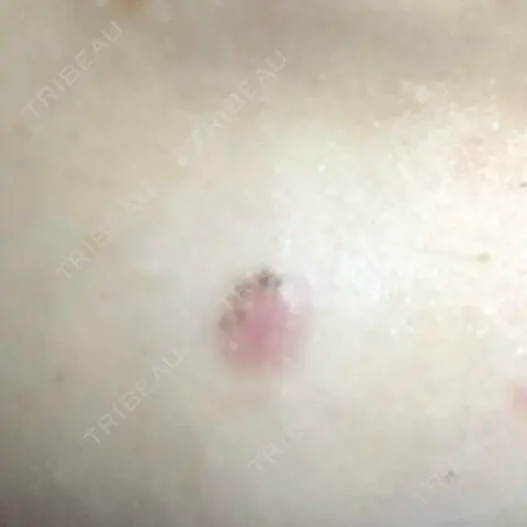 ほくろ・いぼ切除（肌） 目白ホワイトクリニック AFTER