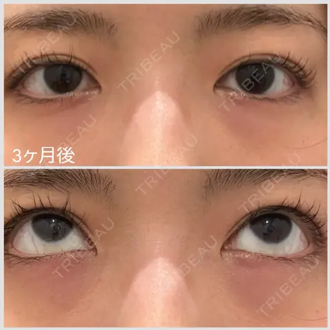 クマ治療 湯田クリニック 銀座 AFTER