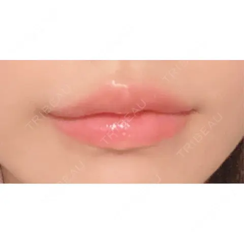 ヒアルロン酸注入（唇） 銀座みゆき通り美容外科 大阪梅田院 AFTER
