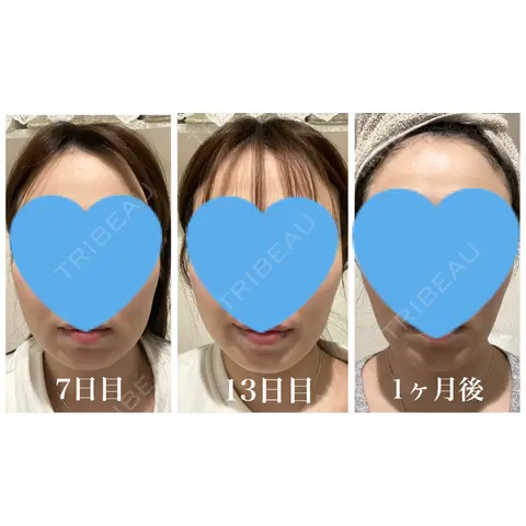 脂肪溶解注射（顔） 日比谷セントラルクリニック AFTER