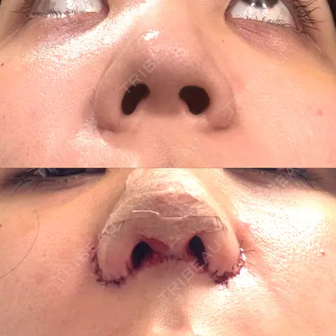 鼻尖形成（切開） / 鼻中隔延長（切開） / 小鼻縮小（切開） / 軟骨移植 RIVER CLINIC（リバークリニック） DAY 0