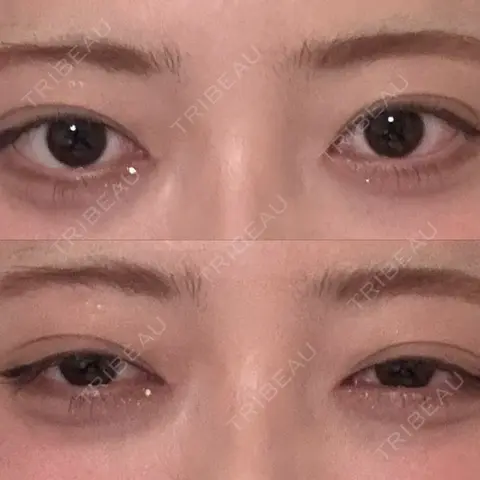 下まぶたたるみ取り / 下まぶたの脂肪取り 東京シンデレラ美容外科 池袋院 AFTER
