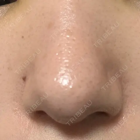 鼻尖形成（切開） / 小鼻縮小（切開） / その他（鼻） 東京形成美容外科 船橋院 AFTER