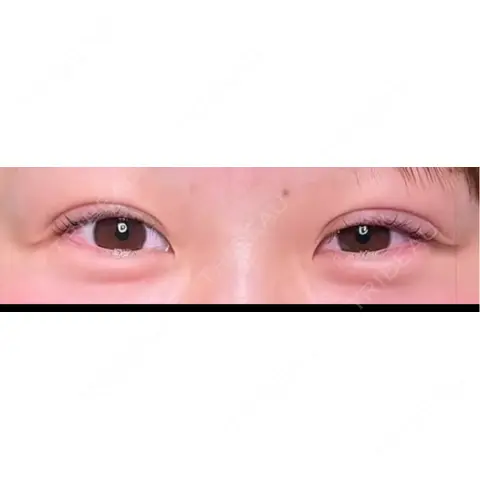 二重埋没 Shion Beauty Clinic DAY 0