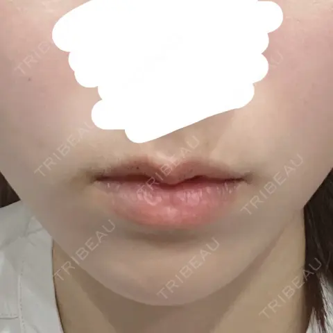 ボトックス（エラ・小顔） TCB東京中央美容外科 札幌大通院 AFTER