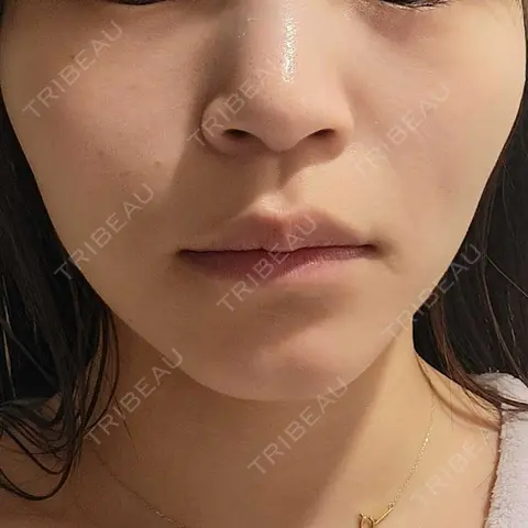 ボトックス（人中） Re:anne clinic 銀座 【リアンクリニック銀座】 AFTER