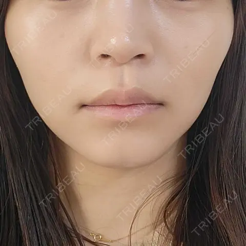 ボトックス（人中） Re:anne clinic 銀座 【リアンクリニック銀座】 AFTER
