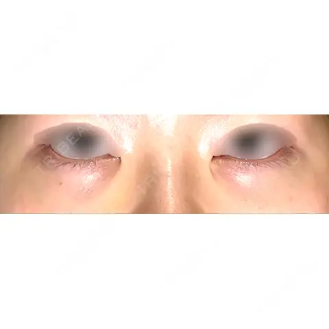 下まぶたの脂肪取り APOLLO BEAUTY CLINIC AFTER