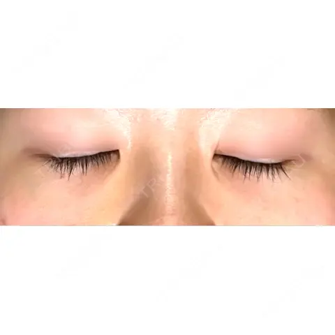 下まぶたの脂肪取り APOLLO BEAUTY CLINIC AFTER