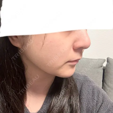 脂肪吸引（顔） Mods Clinic（モッズクリニック） 東京院 AFTER