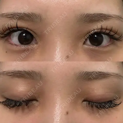 二重切開 / 目頭切開 オーキッド美容クリニック東京御徒町 AFTER