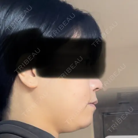 脂肪溶解注射（顔） 日比谷セントラルクリニック DAY 0