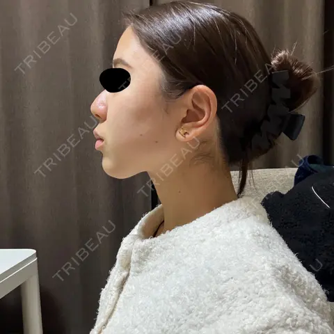 RF（高周波）たるみ治療 TUNE CLINIC【チューンクリニック】 AFTER
