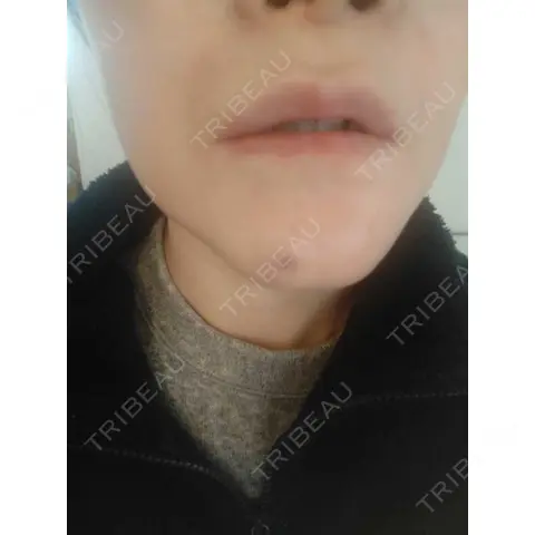 脂肪溶解注射（顔） 目白ホワイトクリニック DAY 1