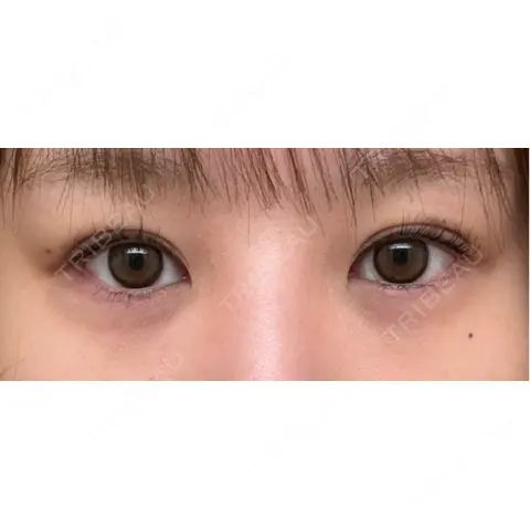 二重埋没 湘南美容クリニック 池袋東口院 AFTER