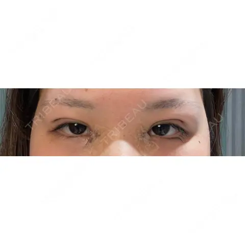 二重埋没 / 目頭切開 / 上まぶたの脂肪取り / 自然癒着法 MEMOTO CLINIC 名古屋 DAY 0