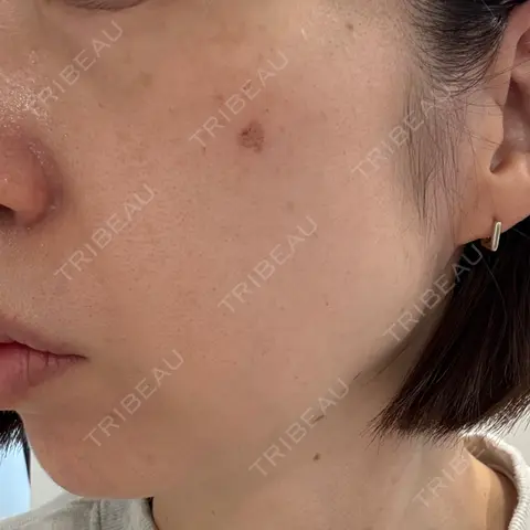 ボトックス（眉間） / 光治療（フォトフェイシャルなど） / ピコスポット Kaleido Clinic（カレイドクリニック） 横浜 AFTER