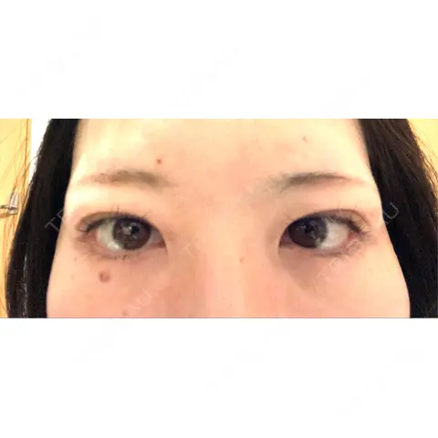 二重埋没 アリエル美容クリニック 大宮院 DAY 0
