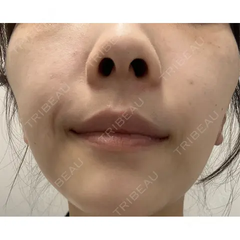 ボトックス（エラ・小顔） L‘amour clinic Tokyo【ラムールクリニック東京】 AFTER