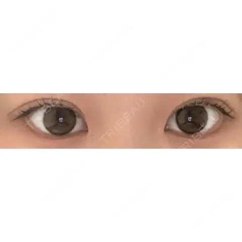 二重埋没 Shion Beauty Clinic AFTER