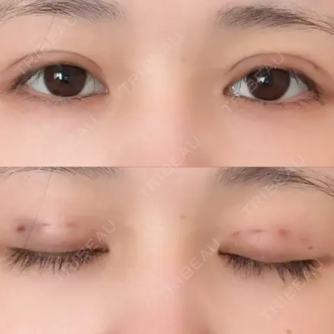 二重埋没 / 自然癒着法 Brandnew Beauty Clinic DAY 0