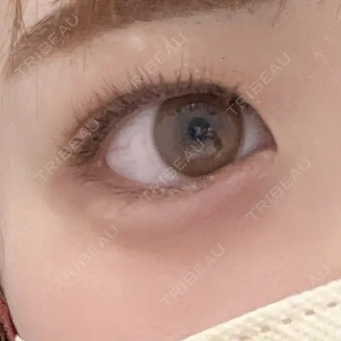 ヒアルロン酸注入（涙袋） AI Beauty Clinic （エーアイ美容クリニック） AFTER