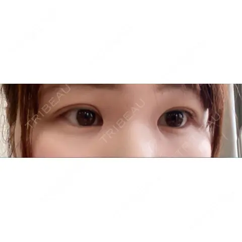 二重埋没 / 上まぶたの脂肪取り / 脂肪溶解注射（顔） TCB東京中央美容外科 前橋院 AFTER